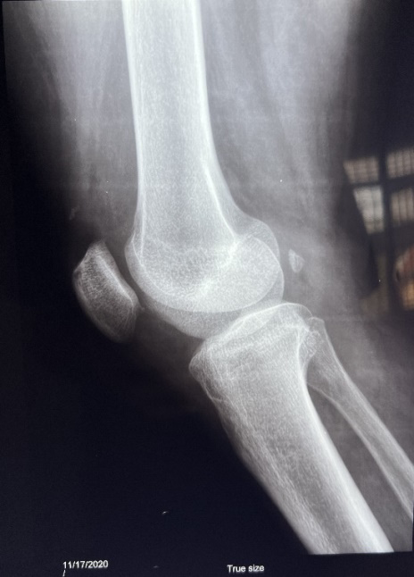 Figure 1: X-ray of the right knee joint (November 2020) - showed features of early degenerative changes.
