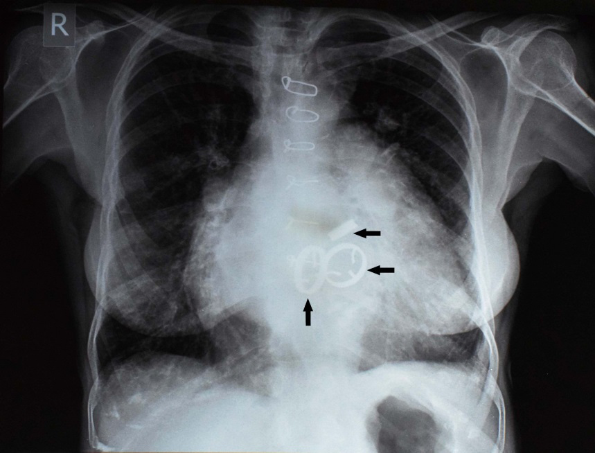 Figure 1: ** Arrows indicating 3 metal prosthetic valves (aortic, mitral, tricuspid) in-situ.