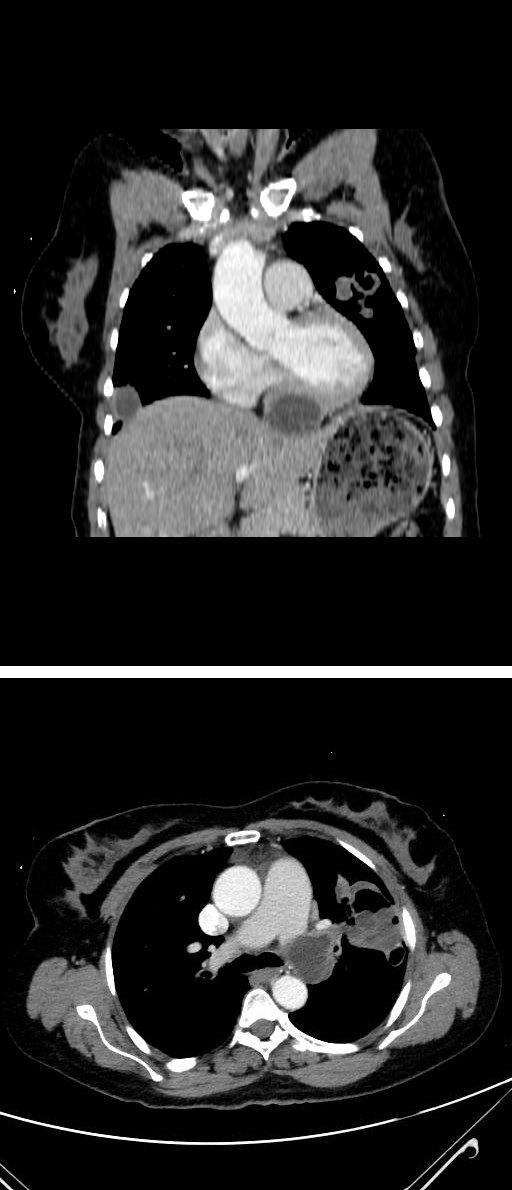 Figure 3: Left pulmonary artery involves type 1 cyst hidatic in axial intravenous non-ionic contrast-enhanced mediastinal window thorax CT (arrow).