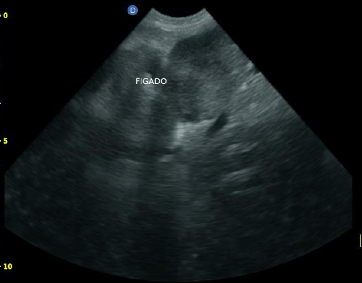 Figure 4: Abdominal ultrasound. Liver exceeding the limits of the costal margin, reaching the middle of the abdomen, with heterogeneous parenchyma and mixed echogenicity suggesting neoplasia.