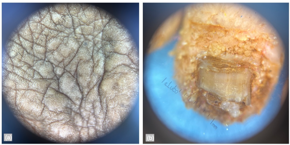 Figure 3: Dermoscopy revealed (a) tire-tread and cracked riverbed-like appearances along with (b) V shaped nicking over the nails.