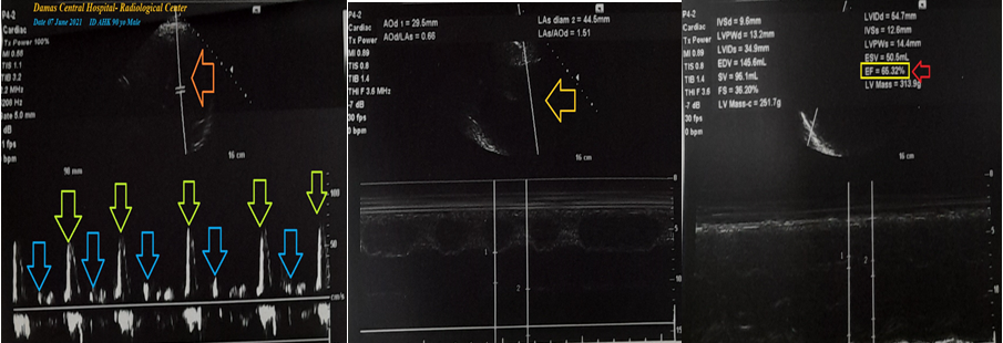Figure 2: Echocardiography was done within 3 days after the POC presentation showing a good LV systolic function of an EF of 65.32% (red arrow), grade I diastolic dysfunction (lime and blue arrows), tricuspid regurgitation, right side dilation (golden arrow), and left atrial dilation (orange arrow).