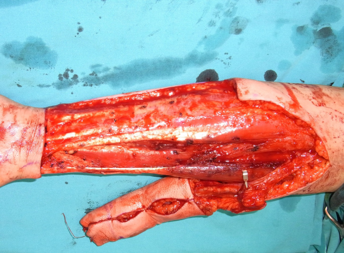 Figure 2: The radial forearm flap was harvested from the left forearm.