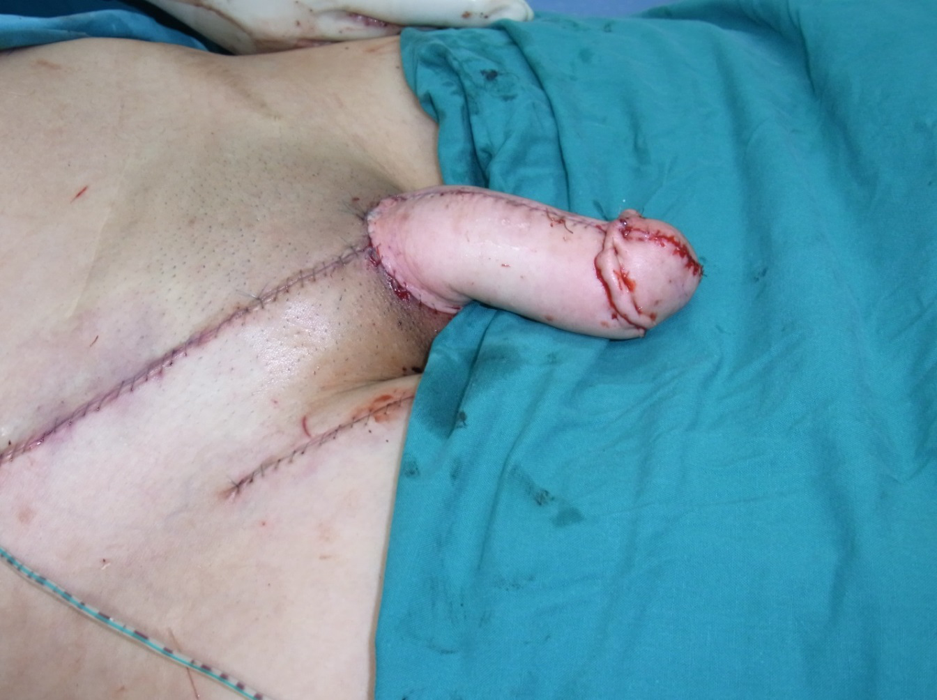 Figure 3: The neophallus was created from the radial forearm flap by microsurgery technique.