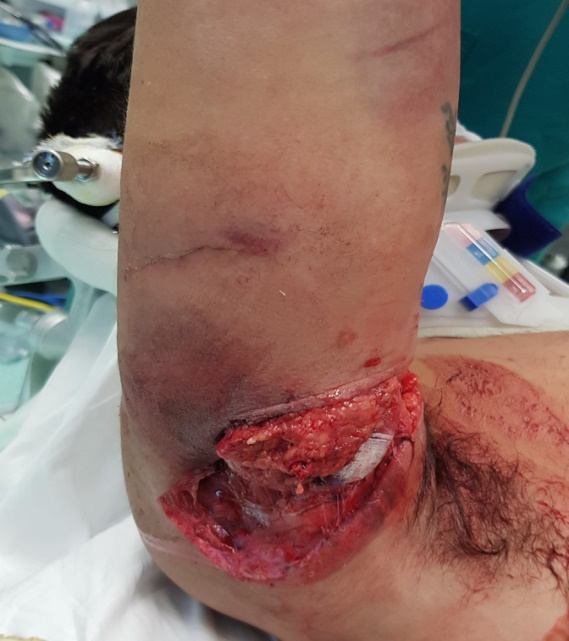 Figure 1: The blunt wound in the posterior aspect of the proximal right arm is shown. Extensive muscle contusion and necrosis is evident.