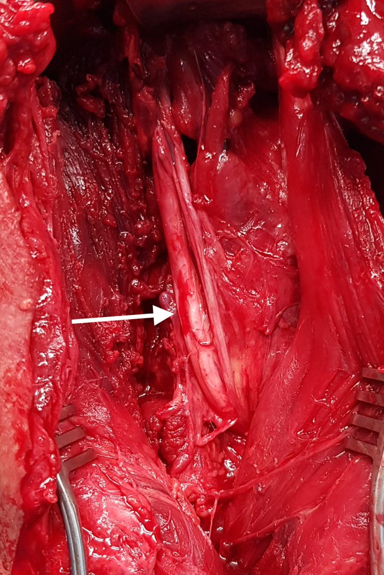 Figure 2: Extensile posterior approach to the proximal right arm of the patient. The elbow is on the upper border of the photograph. The radial nerve was explored using microsurgical technique. The radial nerve was found to be bifurcated. The thicker lateral nerve trunk (white arrow) had an epineural hematoma, and the smaller medial trunk was intact.