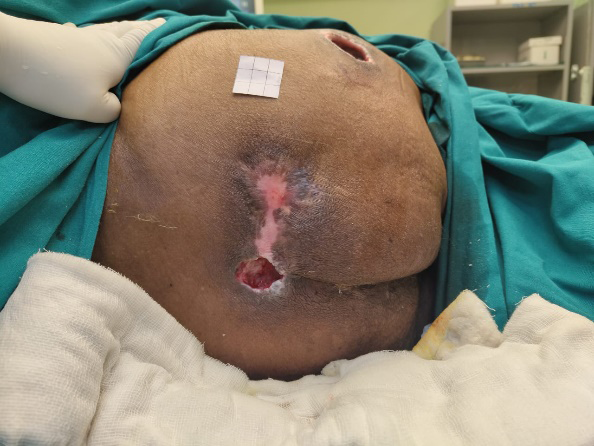Figure 1: Sacral pressure injury with stage D (3+); IS (3+); PS (0); RC (4) at admission.