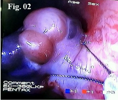 Figure 2: Polypectomy was Performed and Specimen Sent for HPE.