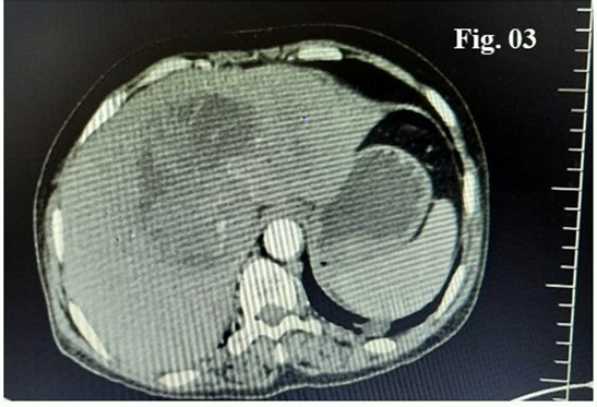 Figure 3: Showing Peripheral Enhancement in Arterial and Washout in Portovenous Phase with Multiple Enlarged Portahepatis, Celiac and Para Aortic Group of Lymph Nodes.