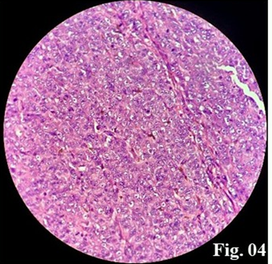 Figure 4: The Histopathology of the Polyp Biopsy Concluded to a Primitive Malignant Melanoma.