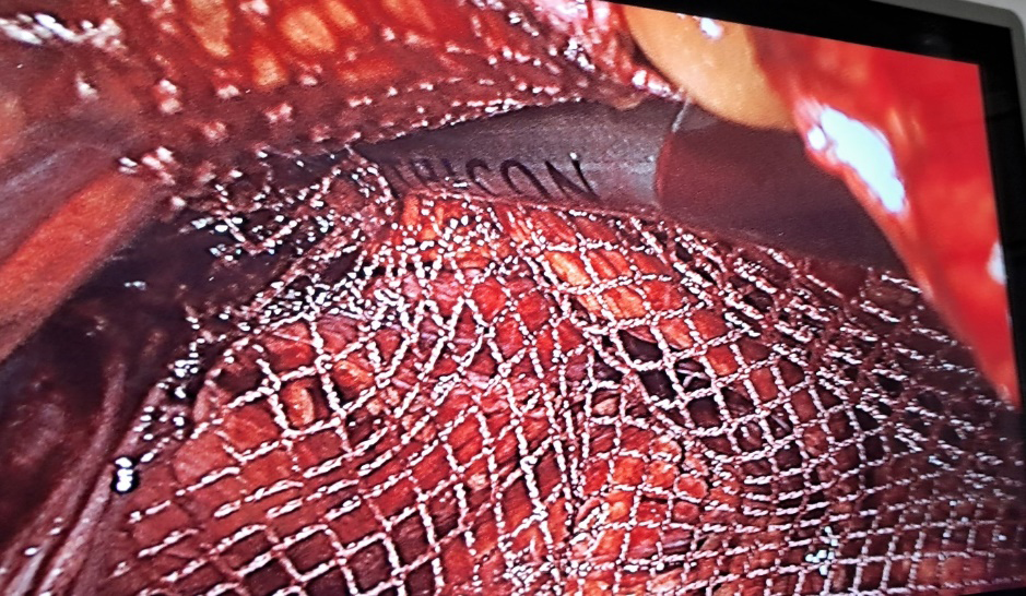 Figure 4: Fixation of Mesh with Tacker.