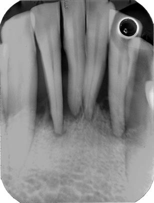 Figure 1: Bone loss more than 2/3rd of root length. Note the dense appearance of the trabecular bone pattern. Also see are nutrient canals.