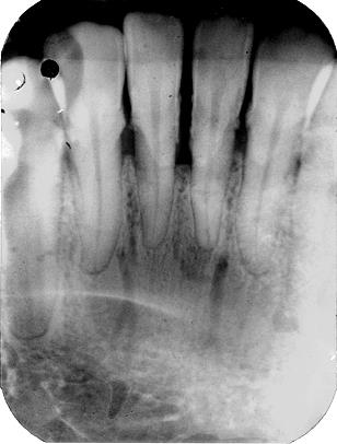 Figure 2: Bone loss upto 2/3rd of root length. Also seen are nutrient canals.