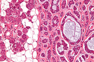 Figure 1: Invasive cribriform carcinoma delineating a distinct cribriform pattern with islands and nests of miniature, mildly pleomorphic epithelial cells surrounded by a desmoplastic stroma [5].