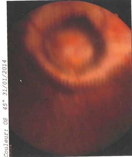 Figure 2: Normal eye fundus to retinophotography of the right eye.