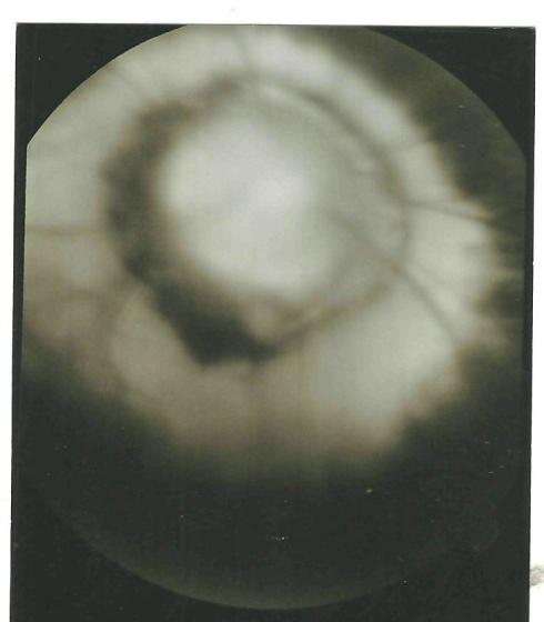 Figure 3: Large papilla, large pigmented ring, important excavation with abnormal disposition of the vessels evoking Morning Glory Syndrome to the retinal angiography with fluoresce in of the left eye. The orbito cerebral CT scan showed no other anomaly on the path of the optic nerve and the cerebral parenchyma. The optic chiasm was normal. At the end of this review, we concluded that it was Morning glory syndrome associated with hypertelorism and agenesis of the nasal pyramid.