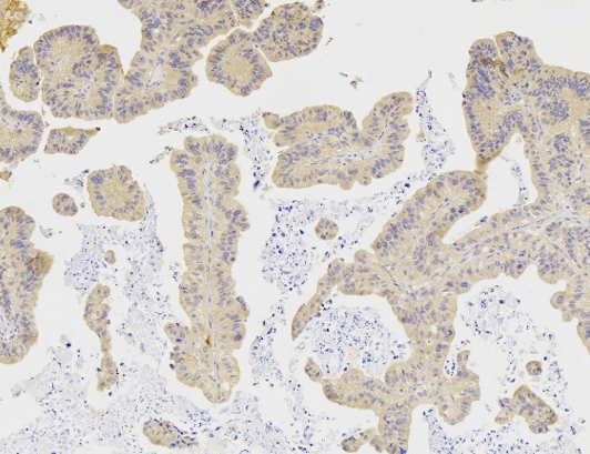 Figure 2: Photomicrograph Showing Positive VEGF Score 2+ in Papillary Type Gastric Adenocarcinoma (X200).