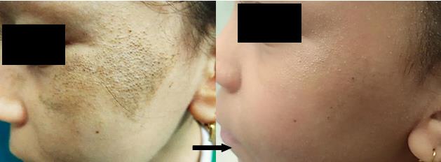 Figure 1: Clinical features before and after treatment, front view.