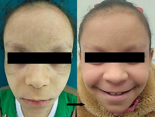 Figure 3: Clinical features before and after treatment, left lateral view.
