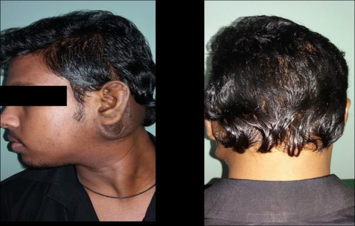 Figure 3: Remission of neck swelling.