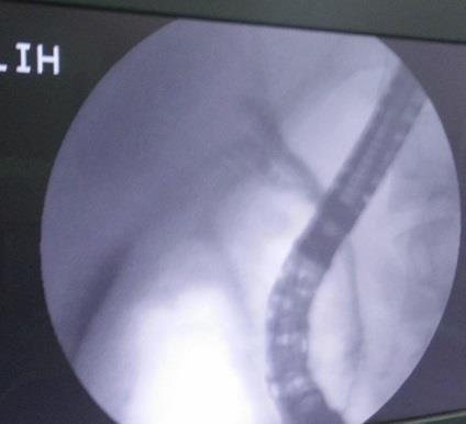 Figure 3: ERCP image showing Leak from the Proximal CBD.