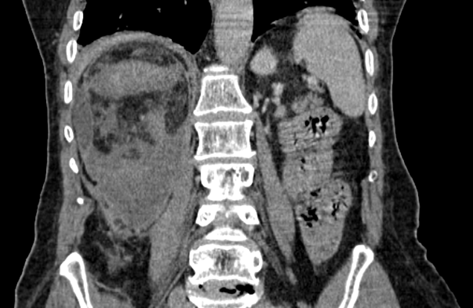 Figure 2: Abdominal-pelvic CT-Scan with PDC injection in coronal section.