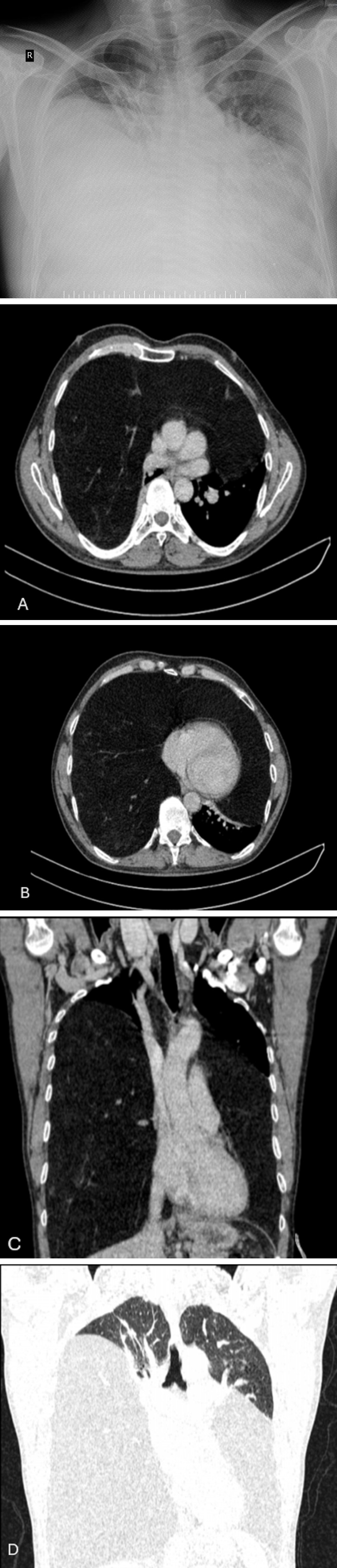 Figure 1: Chest X-ray, P-A view: shows huge mass in the thoracic cavity on both sides.