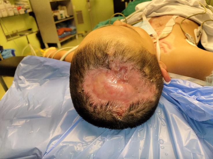 Figure 1: Electrical burn raw area on scalp.