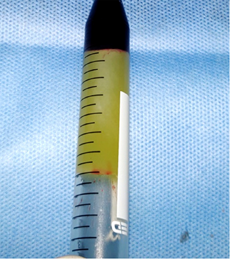 Figure 2: Platelet rich fibrin matrix.