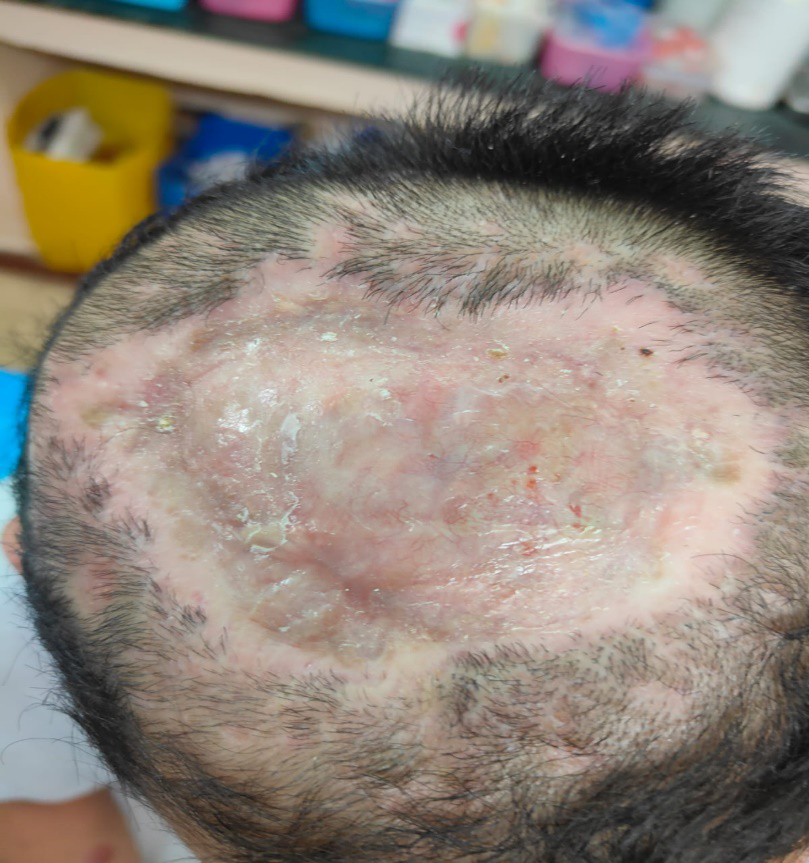 Figure 4: Healed area over scalp after application of PRF.