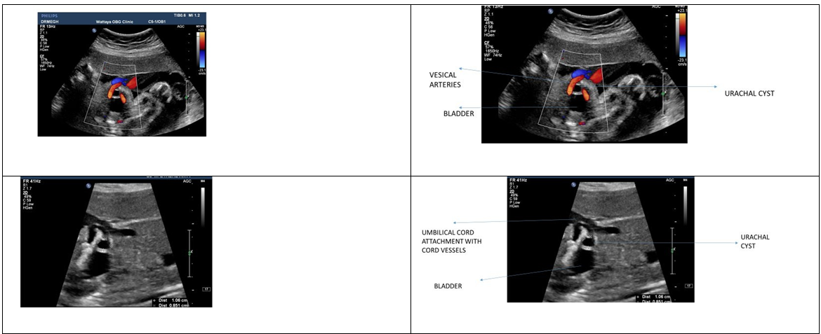 Figure 4: Ovarian cyst.