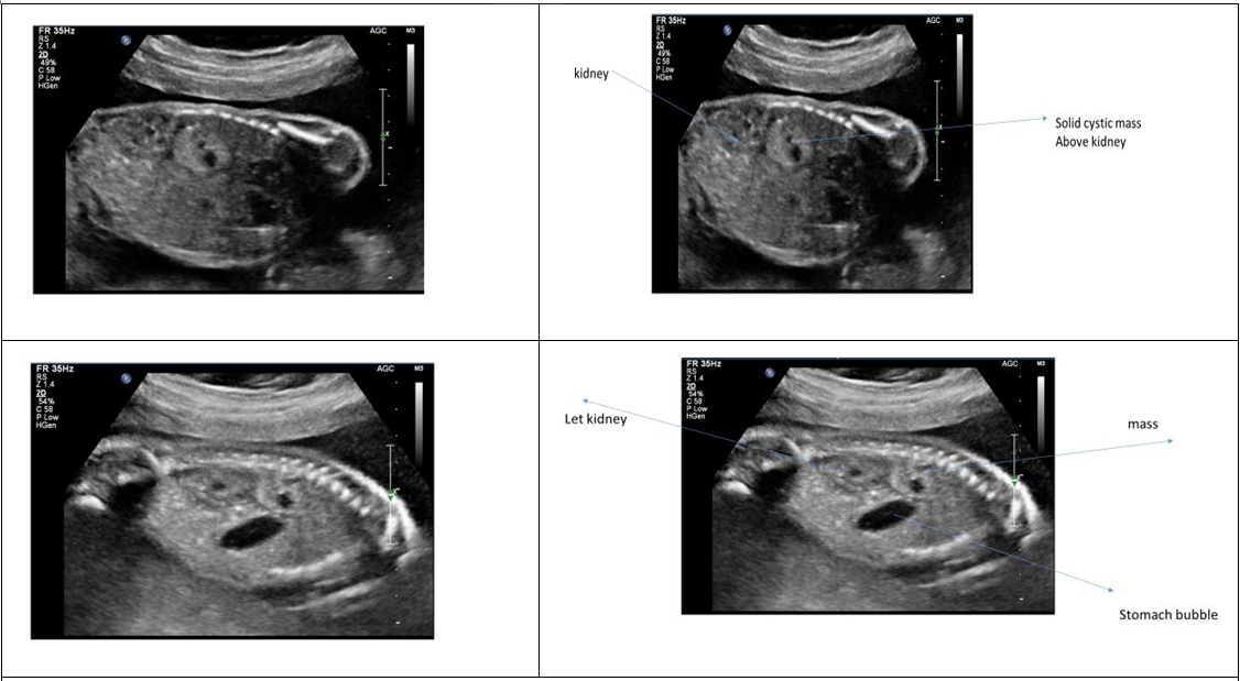Figure 6: Renal cysts.