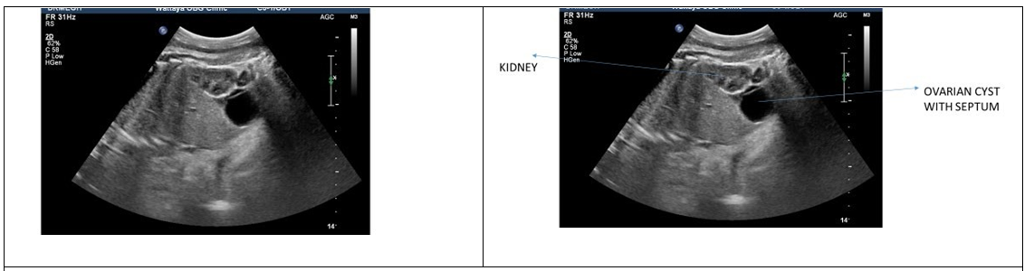 Figure 8: Urachal cysts.