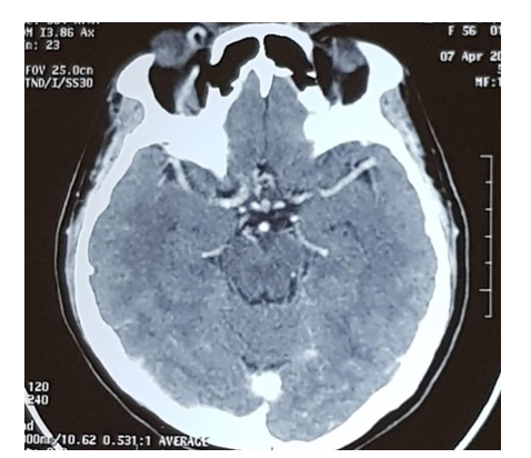Figure 4: Axial CT head scan with contrast demonstrates right sided superior ophthalmic vein dilatation.