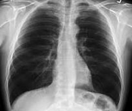 Figure 2: Chest X-ray of normal lung without TB infection. Dark areas show no TB infection.