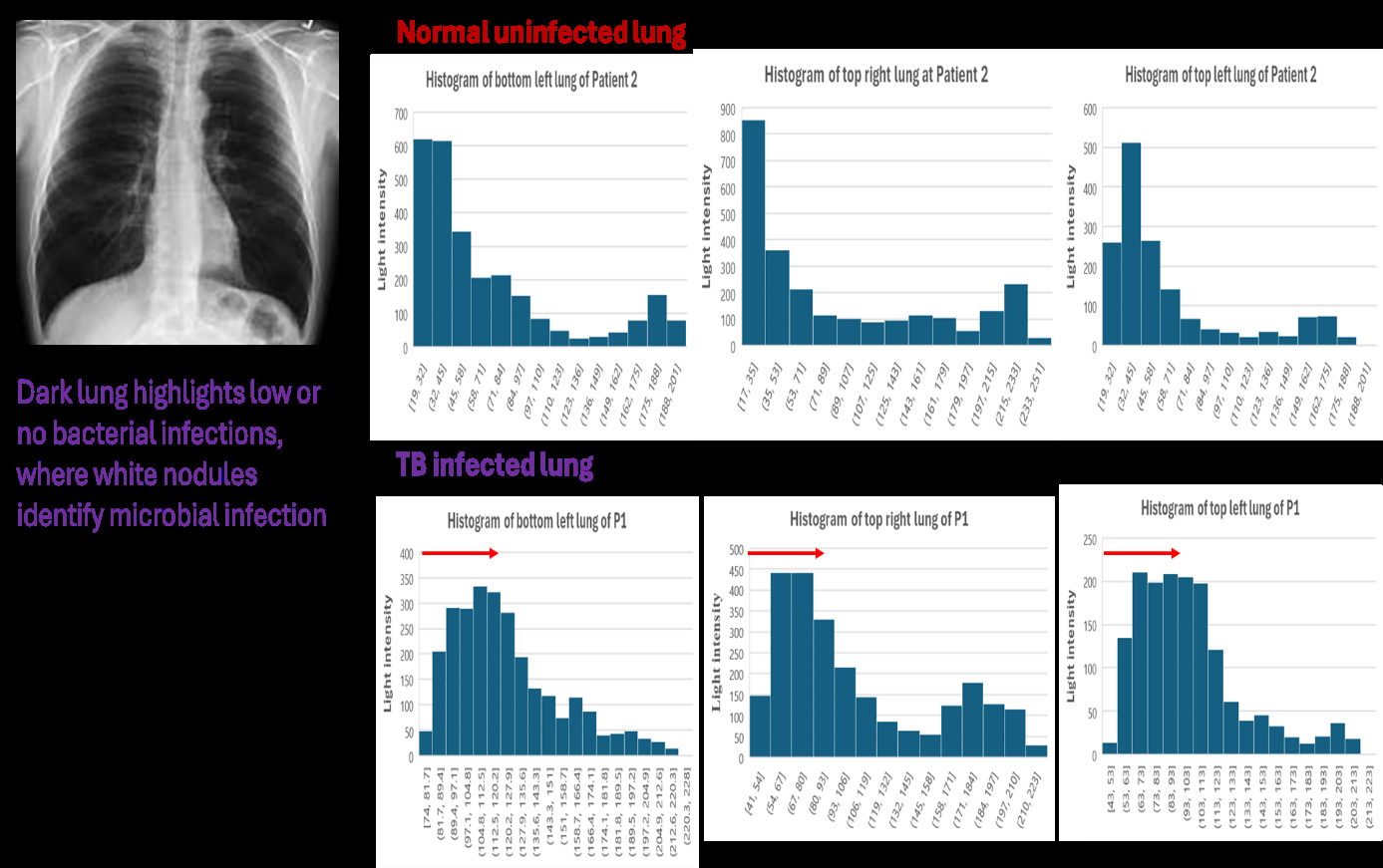 Figure 6: Histogram analysis of pixel intensity distribution of normal chest X-ray and that of TB infected lung reveals rightward shift in histogram diagram towards higher pixel intensity, indicating the presence of white patches or nodules in the lung.
