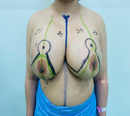 Figure 2: Marking of the inferior pedicle mammoplasty.