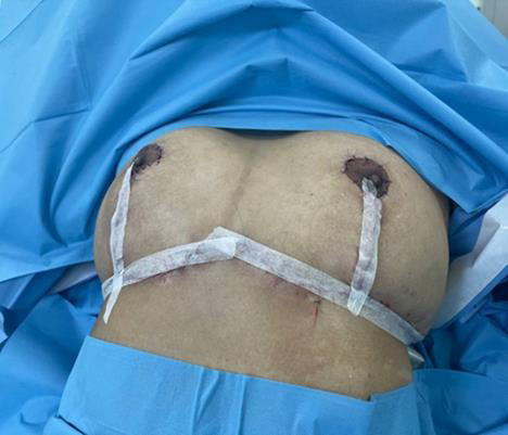 Figure 5: Immediate postoperative result of inferior pedicle mammoplasty and resection of the masses.