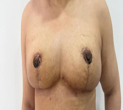 Figure 6: Postoperative picture of the patient after 1 month from the operation.