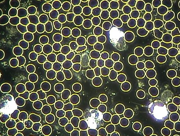 Figure 4: Blood of same male, 65, after drinking 1.5 liters ERW for 6 months. This biological terrain is normal and healthy. Several white blood cells are also seen here.