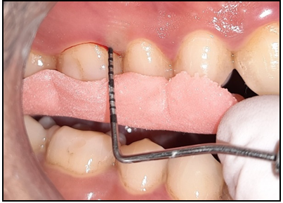 Figure 2: Preoperative Probing Depth.