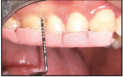 Figure 3: Post Op Probing.