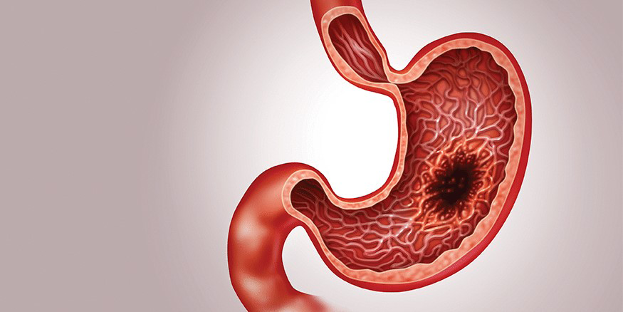 Figure 6: Gastric Adenocarcinoma.