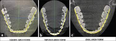 Figure 5: Shows Square Arch Form, Square Arch Form and Ovoid Arch Form.