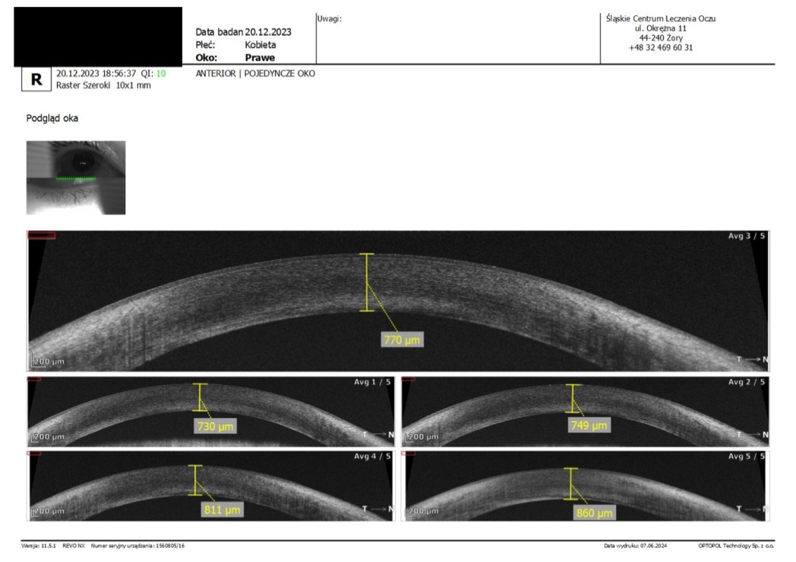 Figure 1: Example measurement of peripheral corneal thickness, performed at the planned location for LRI.