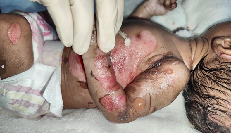 Figure 3: Nails showing yellowish discoloration.