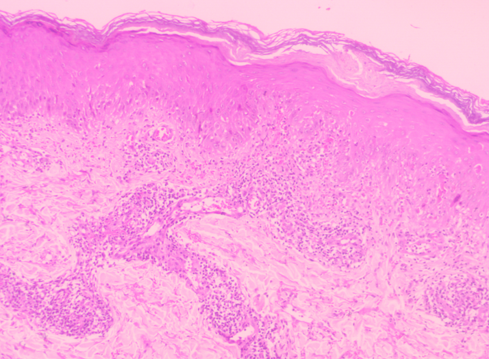 Figure 5: Healing with granulation tissue.