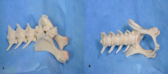 Figure 2: Lumbosacral 3D Models. Dorsal-lateral (A) and ventral (B) views of the 3D model of the canine lumbosacral spine used for this study. The vertebral models were printed using CT scan information of a 3- year-old neutered male Beagle using ABS polymer. The canine vertebral models were generated using a 3D printerd, an additive manufacturing method in which an object is created by depositing powdered material in layers that are then selectively joined with a binding polymer from an inkjet print head. Each layer represents a thinly sliced horizontal cross-section of the sample object [17]. The vertebral models were printed with acrylonitrile butadiene styrene (ABS), a production-grade thermoplastic polymer with an elastic modulus or a Young’s modulus of 2.4 GPa. The elastic modulus of trabecular bone ranges from 0.01 to 10 GPa, and that of dense cortical bone is approximately 11GPa, thus placing the elastic modulus of ABS within the range of that cancellous bone and somewhat lower than that a cortical bone [11]. The vertebrae were printed with solid ABS. The resolution of the printer was 0.25 mm. We chose ABS because of its elastic modulus, ability to be printed, and ability to be machine worked. ABS can be drilled and tapped, and screws can be removed and replaced without visible disruption to the model or material. All models were printed in the same orientation to ensure consistency in reconstruction. The vertebral models were rendered with Hounsfield units for bone (+700 [cancellous bone] to +3000 [dense bone]) with no soft tissue components, and the intervertebral discs and the ligamentous and joint capsule were excluded from being rendered or printed. The articular facets were printed as contiguous polymer reconstruction units. All bone was printed with homogenous ABS without maintaining gradients of bone density and with no differentiation between cortical and cancellous bone.