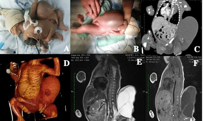 Figure 1: The First Case of Fetus in Fetu in Nicaragua.