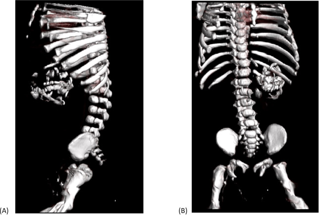 Figure 2: 3D VRT images (A and B) reveal multiple bony fragments, including the spine, ribs, and both upper and lower limbs of the parasitic fetus.